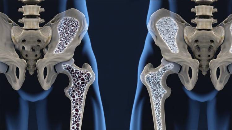 Osteoporose: O que é, como prevenir e quais as formas de tratamento?
